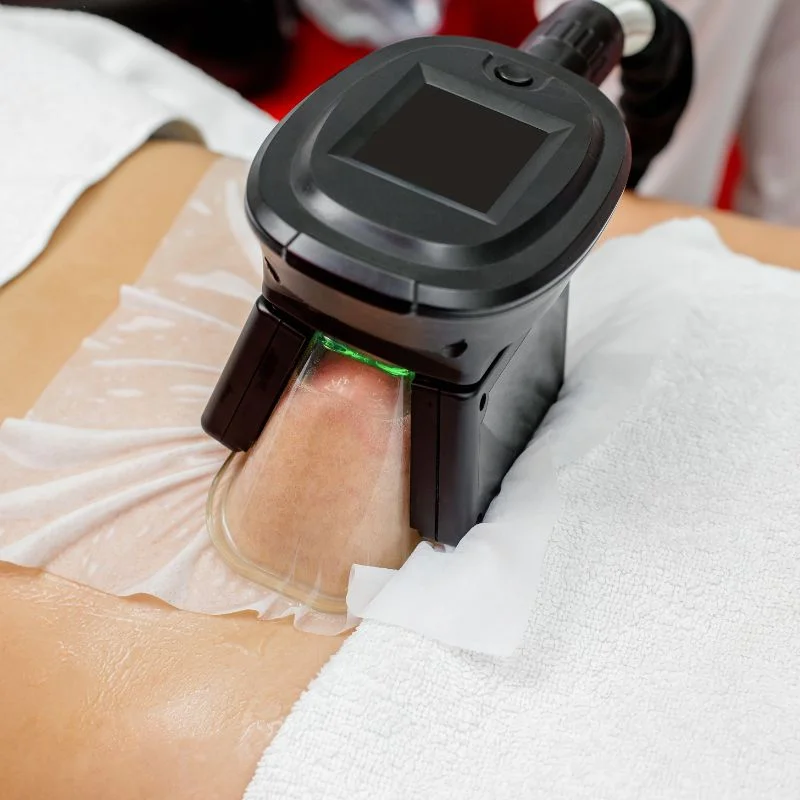 Fat Freezing treatment West Bromwich
